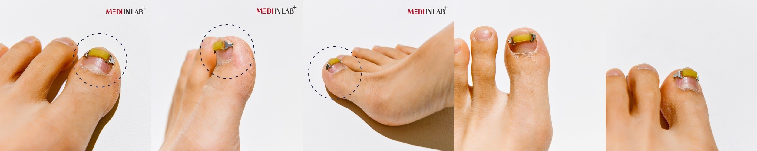 메디인랩 내성발톱 교정기 교정 파고드는 내향성 발톱 테이프